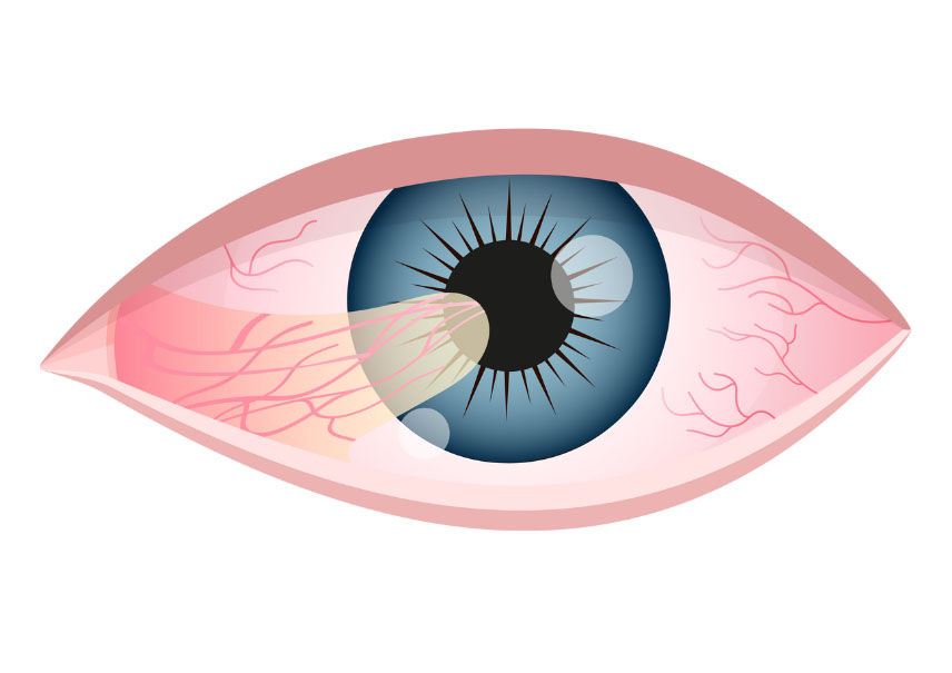 Лечение птеригиума в Германии
