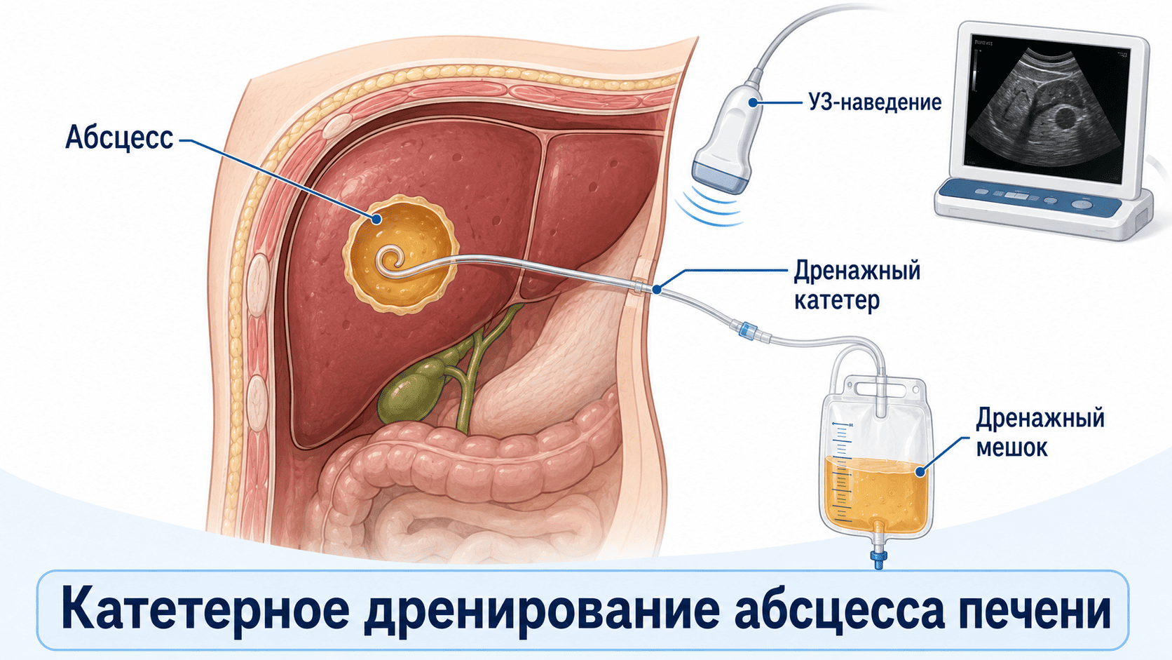 Методы лечения абсцесса печени в Германии