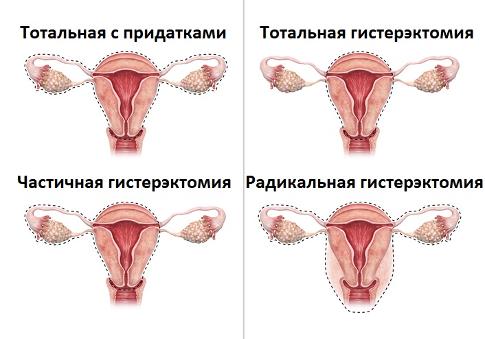 Виды гистерэктомии (экстирпации матки)