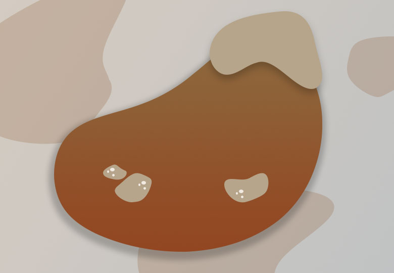 Кисты почек: причины, симптомы и современные методы лечения, Германия