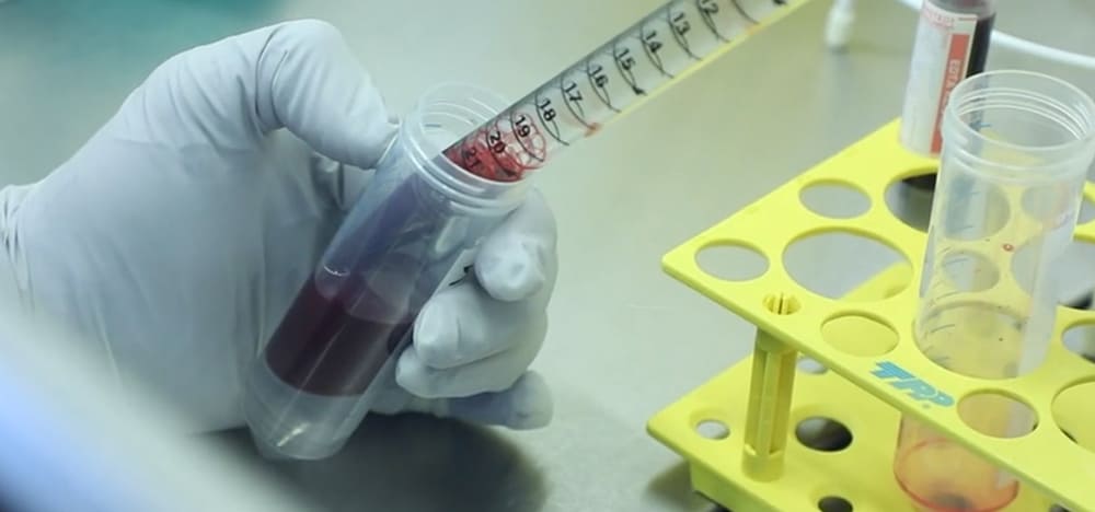 Эпкоритамаб — новая терапия биспецифическими (CD3 Х CD20) антителами для пациентов с диффузной крупноклеточной В-клеточной лимфомой (ДККЛ).