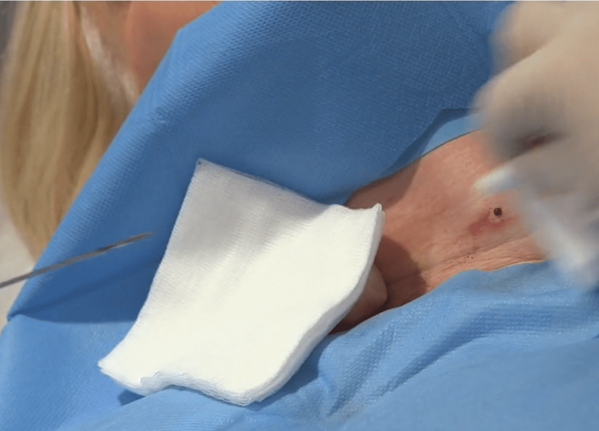 Процедура термоабляции узлов щитовидной железы в Германии