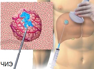 Лечение гепатоцеллюлярного рака в Германии с помощью чрескожной инъекции этанола