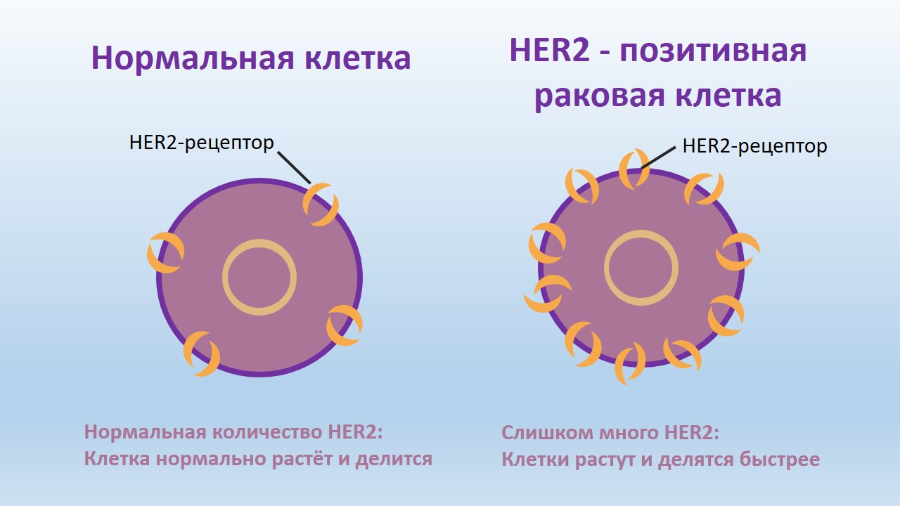 Her2-позитивный рак молочной железы