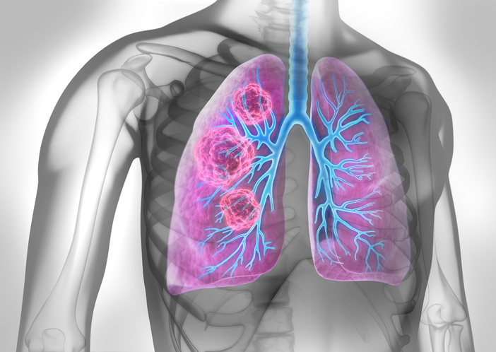Лікування раку легень в клініках Німеччини