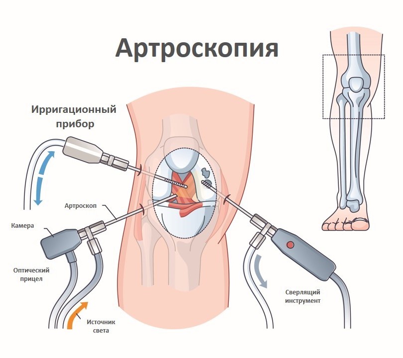 артроскопия коленного сустава