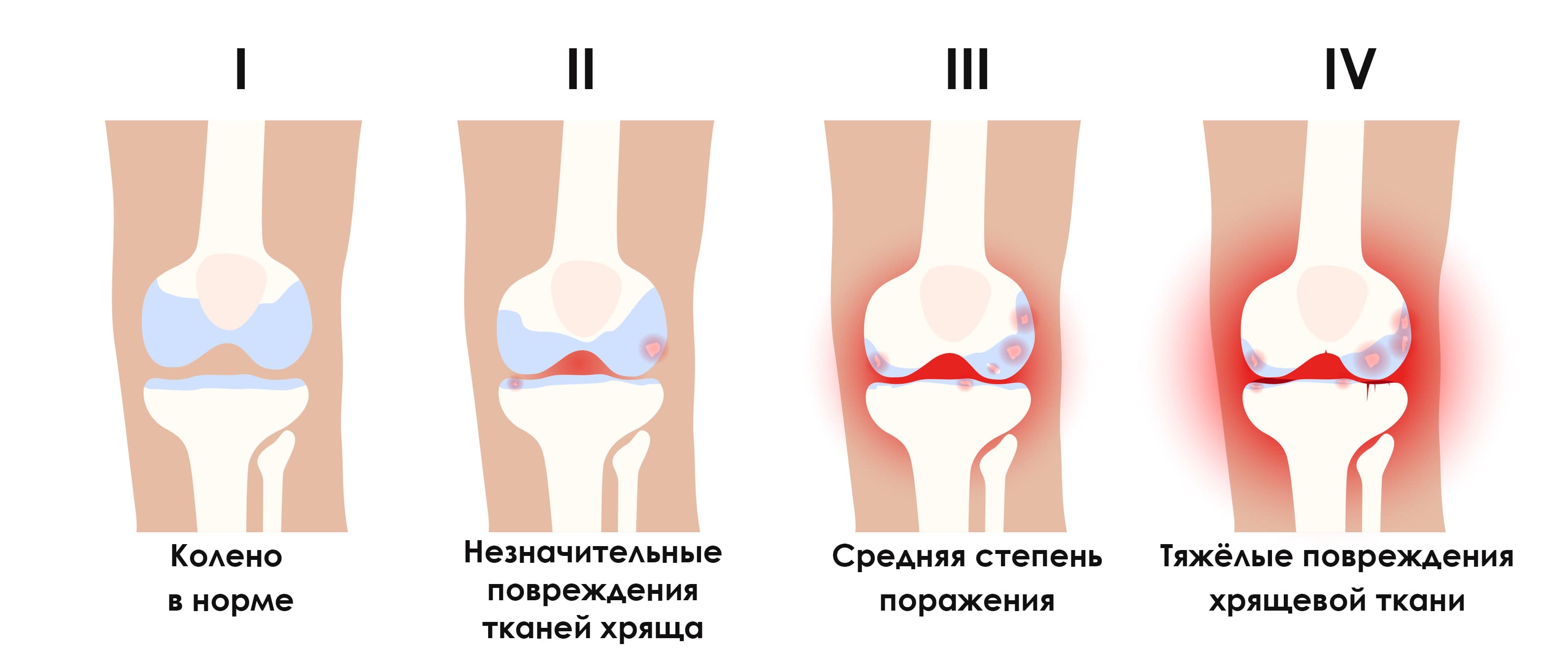 Какие уколы делают в колено при артрозе
