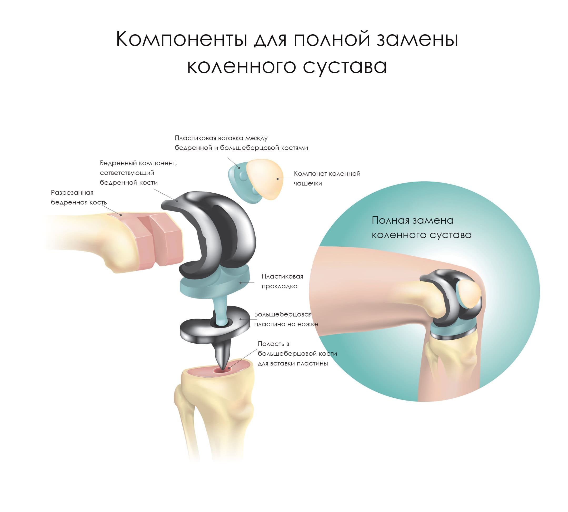 Компоненты протеза коленного сустава
