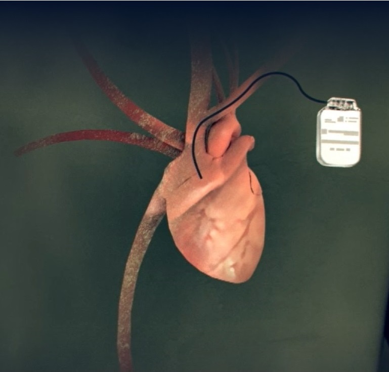 Имплантируемый кардиовертер-дефибриллятор (ИКД)