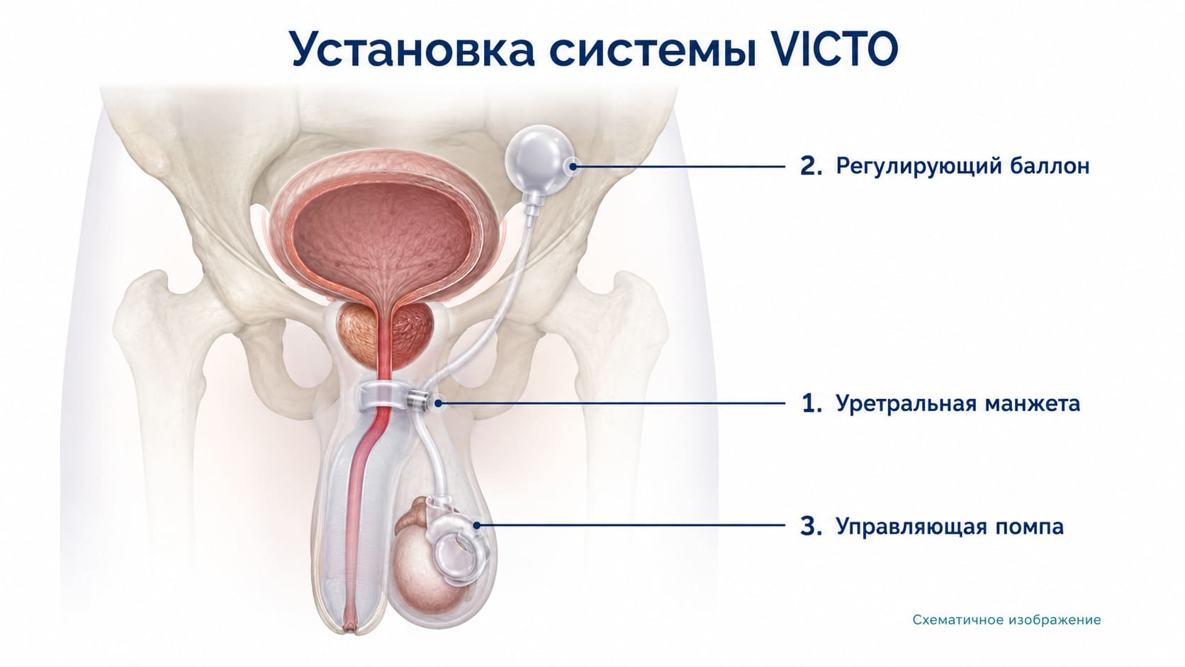 Как устанавливается система VICTO при мужском недержании мочи