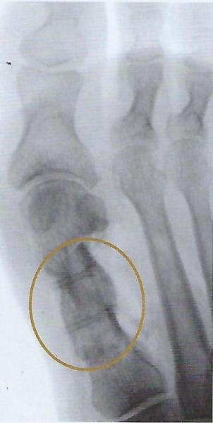 Рентген-снимок с винтами сразу после операции